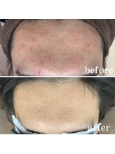 キビック(KIBIK)/【プラズマシャワーで肌質改善】