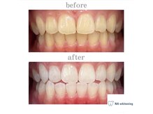 エヌエーホワイトニング たまプラーザ店(NAホワイトニング)/ビフォーアフター