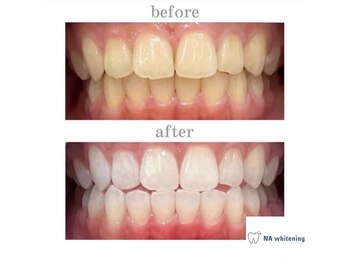 エヌエーホワイトニング たまプラーザ店(NAホワイトニング)/ビフォーアフター
