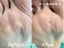 ディオフット(DIO FOOT)/魚の目・タコの除去[フットケア]