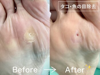 ディオフット(DIO FOOT)/魚の目・タコの除去[フットケア]