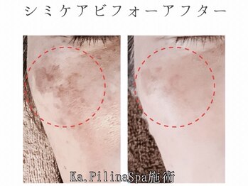 カピリナスパ(Ka.Pilina Spa)/シミケア7回目 before⇒after