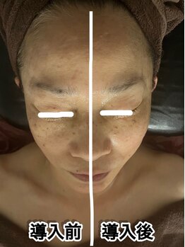 リブラザバランス(LIBRA the balance)/ヒト幹細胞培養液導入のみ