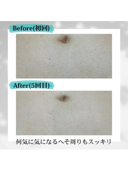 ナンバーフォー 池尻大橋(No.4)/Before & After (腹部)