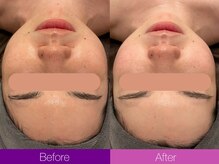 クレヴィア バイ サイバーエステ(CREBIA)/【高濃度水素水ピーリング】