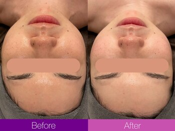 クレヴィア バイ サイバーエステ(CREBIA)/【高濃度水素水ピーリング】