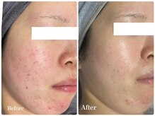 ブロッサム(Blossom)