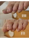 ずっと悩まれていた足の爪