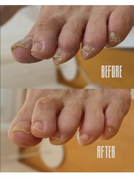 ずっと悩まれていた足の爪