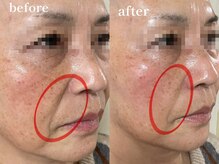 エピリス(Epiliss)/ほうれい線 ビフォーアフター