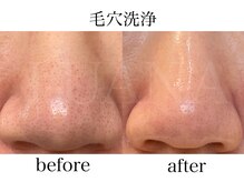ルアナ(LUANA)/毛穴洗浄