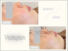 ヘティ バイ ソウル 中目黒(HETIY by Seoul)/水分供給・保湿ケア◇１回目