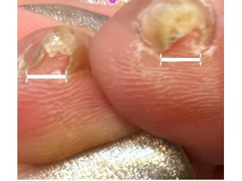 専用ジェルで和らぐ巻き爪ケア！