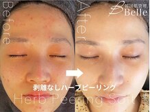 ベル 水戸(Belle)/ハーブピーリング|ニキビケア