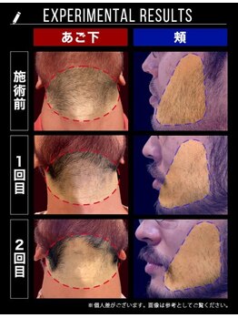 RBL 川崎店/メンズ脱毛/ヒゲ脱毛経過