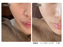 エミルカ 宮崎店(EMILUCA)/小鼻の赤みも目立ちにくく！