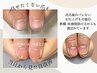 初回から人工的に爪を作り見た目改善◇お試しハンド深爪矯正¥13,900