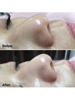 ルル(LuLu)/鼻スッキリ　毛穴吸引