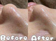 グラシア 倉敷店(Gracia)/ハイドラ毛穴洗浄