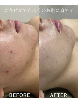 サロンドジェシカ(salon de Jessica)/ハーブピーリングでニキビケア！