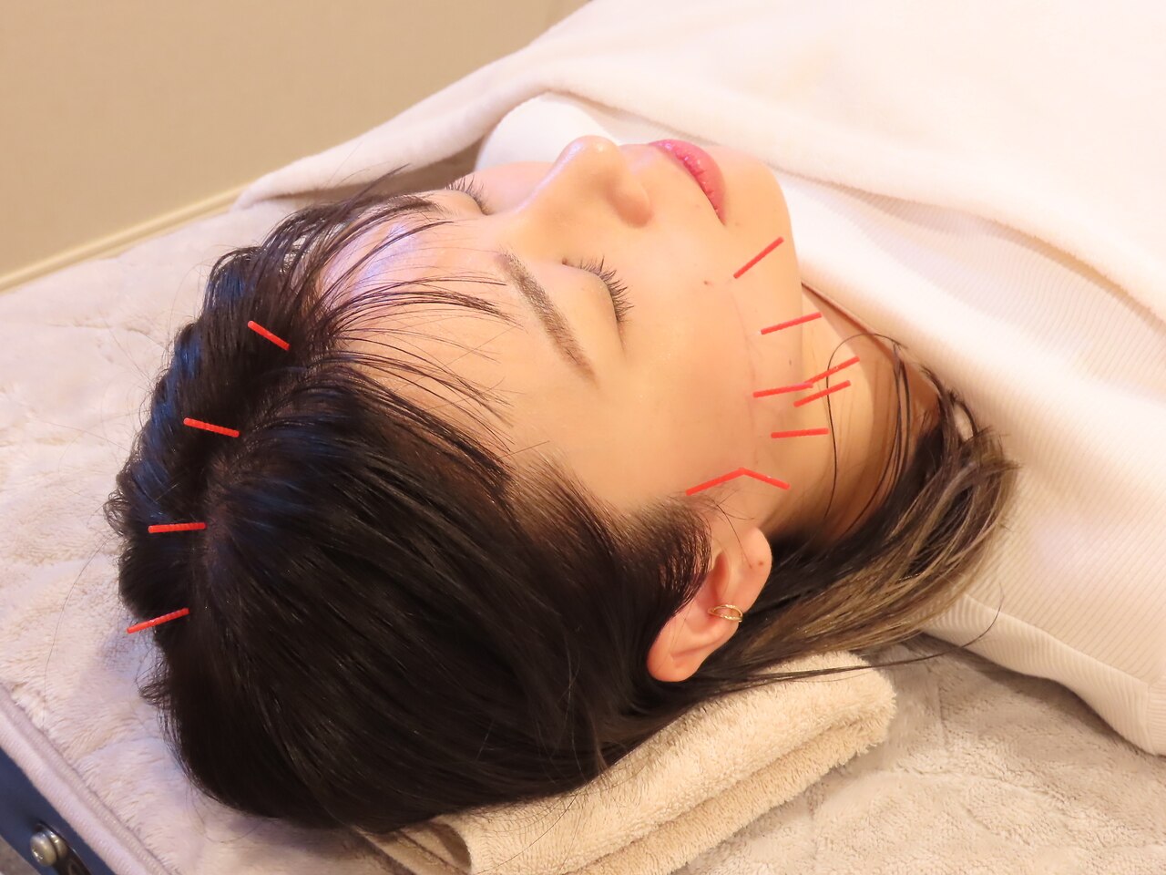 【結婚式や推し活前にオススメ】小顔矯正×美容鍼or首肩調整 \15000→\7500