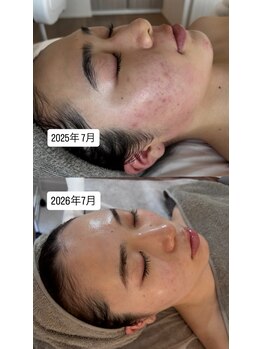 ジェルム(germe.)の写真/皮脂バランス、乾燥により赤みの原因は人それぞれ。
カウンセリングを行い、素肌を育てるケアを意識。