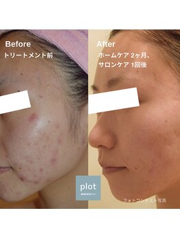 プロット 大阪本店(plot)/LDM・エステ版ポテンツァ 施術
