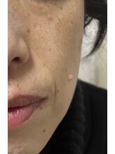 ピュアージュ/神業エイジング▼ほうれい線/後