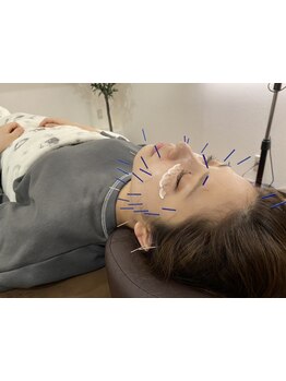 鍼灸施術を受けたい