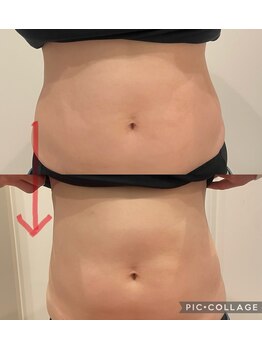 ルナート(Lunart)/腸もみの一回の変化