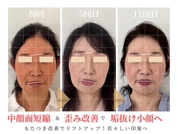 エソア(esoa)/小顔矯正×光フォト