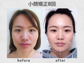 ビトリア 横浜店(BITORIA)/本格小顔矯正