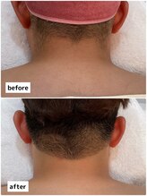 プレヴェール 神戸三宮/メンズうなじ脱毛