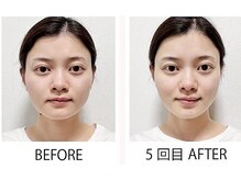 【ビフォーアフター】小顔＆リフトアップ☆綺麗なフェイスライン