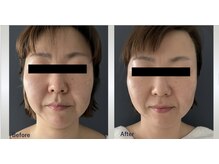 マリー エクラン/40代女性　リフトUP施術