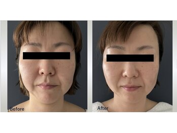 マリー エクラン/40代女性 リフトUP施術