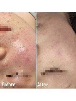 コルギ デ コガオ(KORUGI de KOGAO)/【業界初スペック】LED&IR 