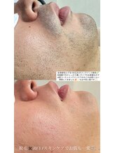 クレヴィー(Creviy)/メンズ髭脱毛