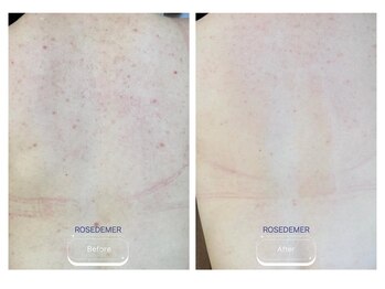 スー 千種 今池(Suu.)/＜症例＞繰り返す背中肌トラブル