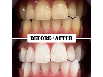 ホワイトニングサロン 豊中/Before&After美白ホワイトニング