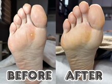 ポドロ ウィズ ニコルル 大阪天満店(PoDoLo with Nicolulu)/【魚の目】フットケア大阪・梅田