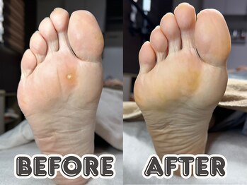 ポドロ ウィズ ニコルル 大阪天満店(PoDoLo with Nicolulu)/【魚の目】フットケア大阪・梅田