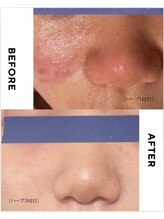 カラーリリー(calla lily)/剥けない幹細胞ハーブピーリング