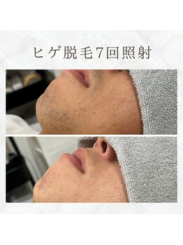 ボゴス 天白店(BOGOSS)/【ヒゲ脱毛】施術写真