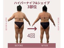 コリ チル(Kori Chill)/【ハイパーナイフ＆シェイプ】