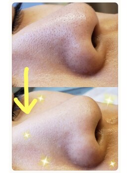 エステココ 石岡店(Esthe CoCo)/【大人気】毛穴吸引コースの結果