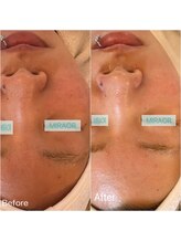 ミラー(MIRAOR)/アンストレス/毛穴黒ずみ赤みも!