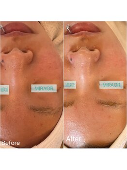 ミラー(MIRAOR)/アンストレス/毛穴黒ずみ赤みも!