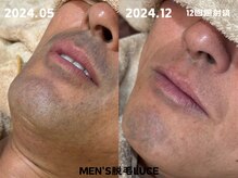 ルーチェ/【ヒゲ脱毛】脱！青髭！