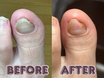 ポドロ ウィズ ニコルル 大阪天満店(PoDoLo with Nicolulu)/【分厚い爪】フットケア大阪